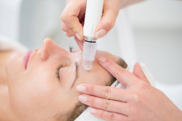 microdermabrasion for pores