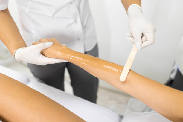 laser hair removal