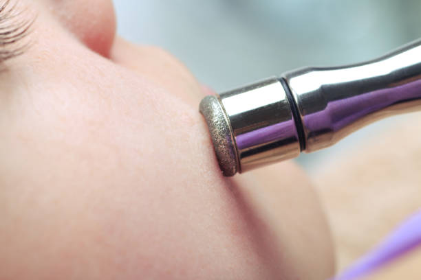 what are the benefits of microdermabrasion